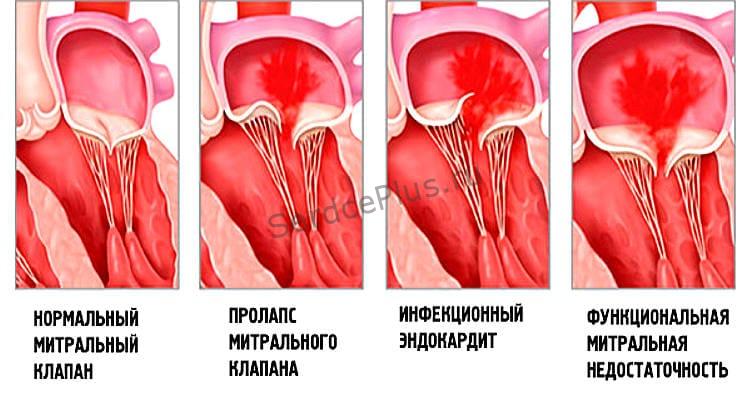Врожденная недостаточность аортального клапана Врожденная недостаточность аортального клапана