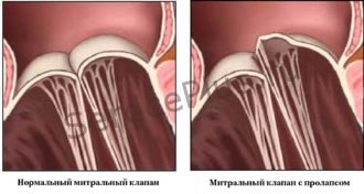 Клипирование митрального клапана Клипирование митрального клапана