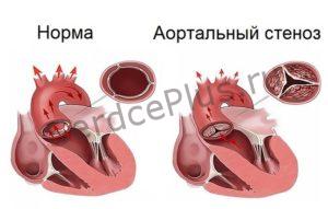 Двухполулунный аортальный клапан Двухполулунный аортальный клапан